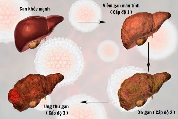 Cac-cap-do-gan-nhiem-mo