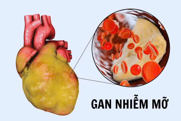 ieu-tri-va-phong-ngua-gan-nhiem-mo