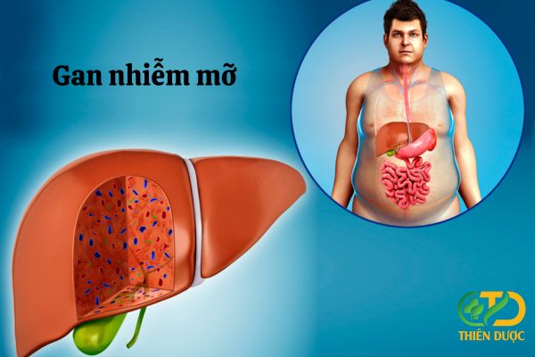 Gan-nhiem-mo-co-chua-duoc-khong