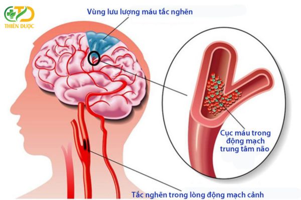 Tai-bien-mach-mau-na-do-mau-huyet-khong-luu-thong